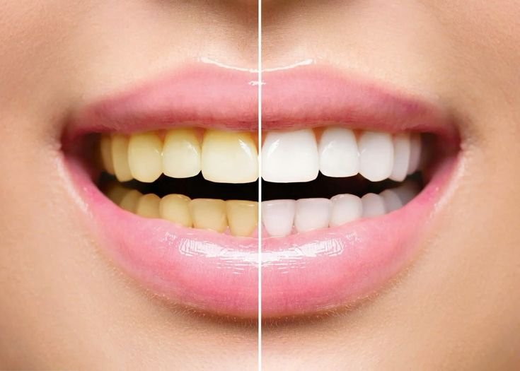 Teeth whitening and veneers