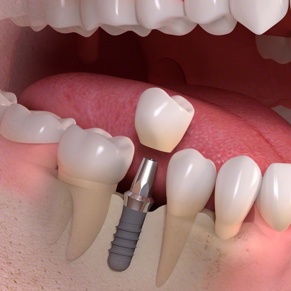Implant