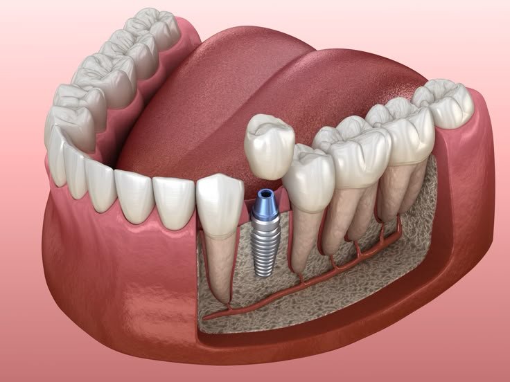 Dental Implants
