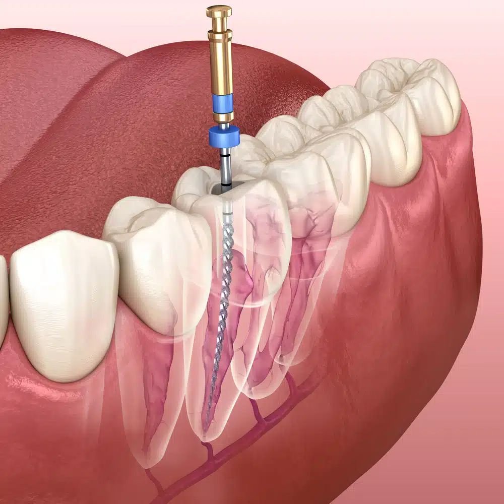 Root Canal Treatment