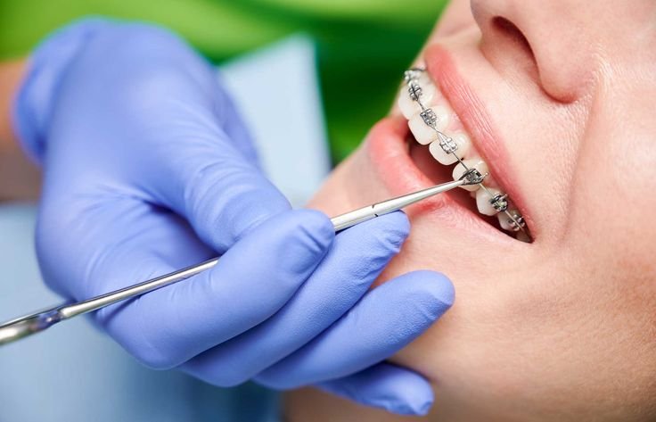 Braces (Orthodontists)