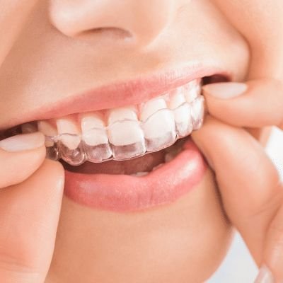 Aligners