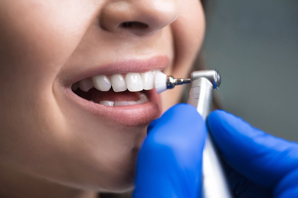 Teeth Cleaning (Scalling & Polishing)