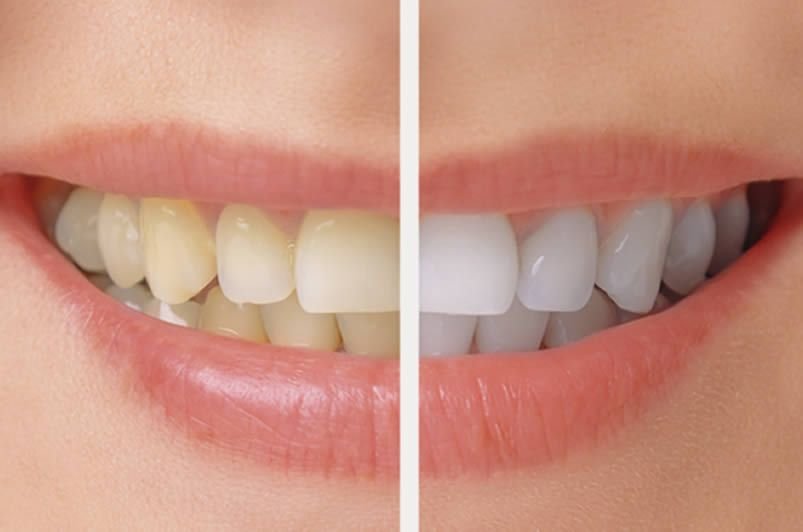 Bleaching Teeth