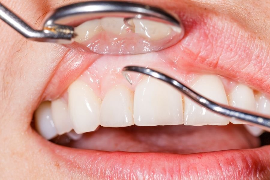 Gum surgeries