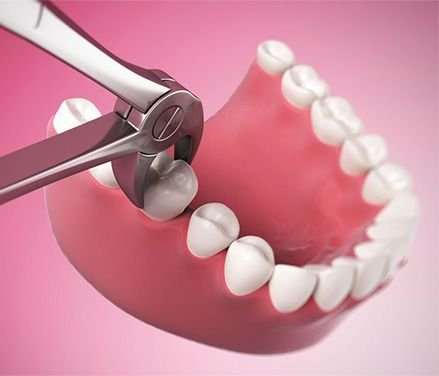 Wisdom tooth extraction