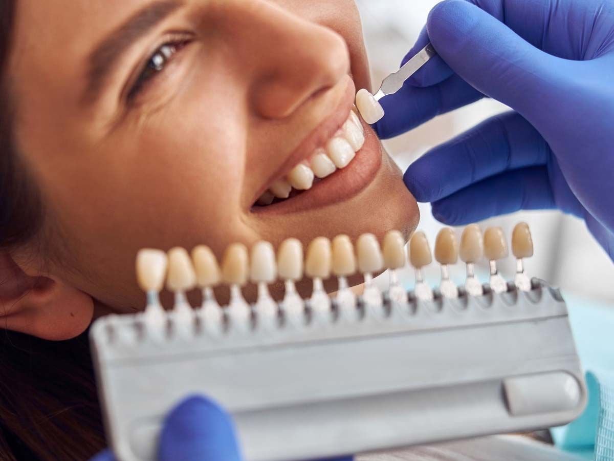 Teeth Veneers