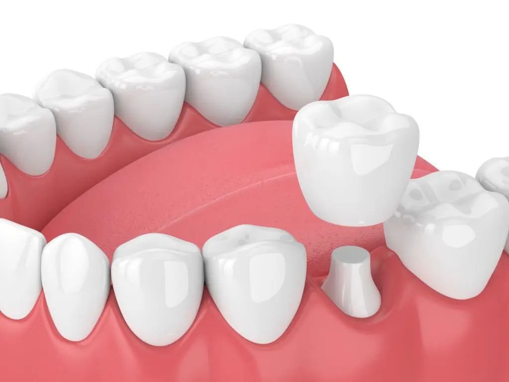 Zirconia Crown