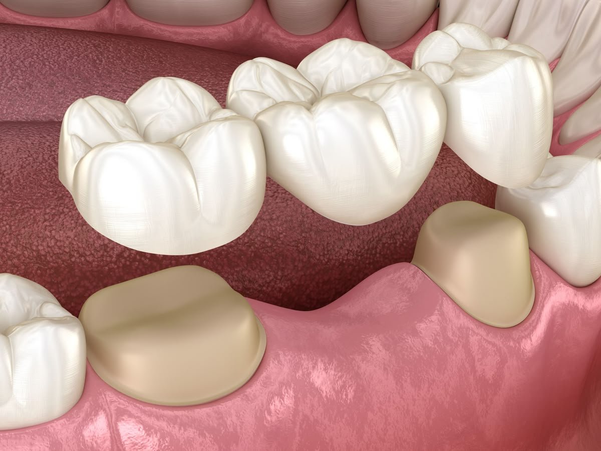 Dentures & Bridges
