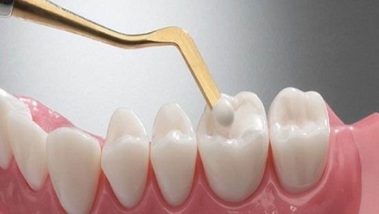 Fillings & Sealants