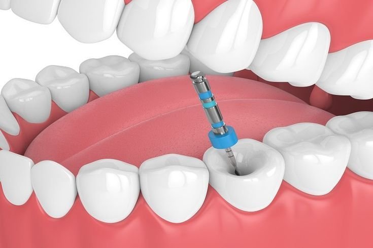 Root Canal
