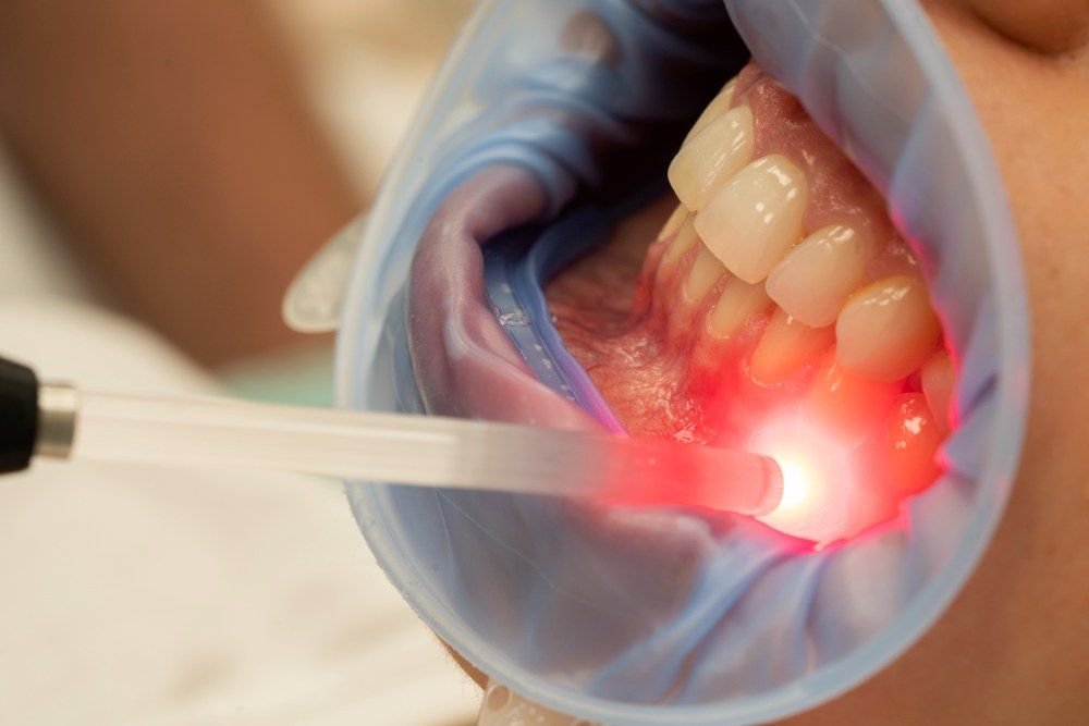 Gum Surgery