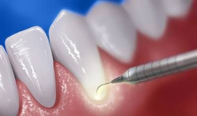 Periodontal Surgery