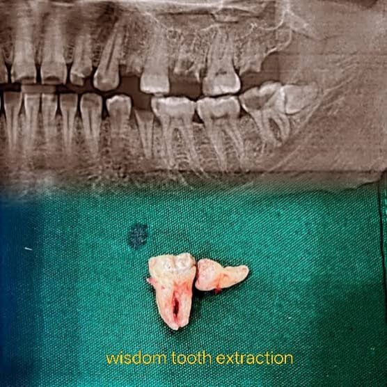 Oral Surgery