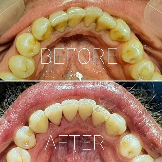 Scaling and Polishing