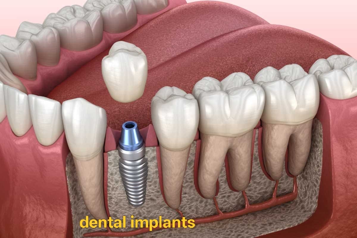 Dental Implants