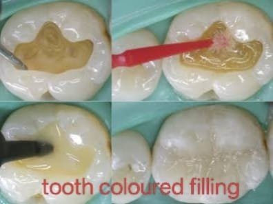 Tooth Coloured Filling